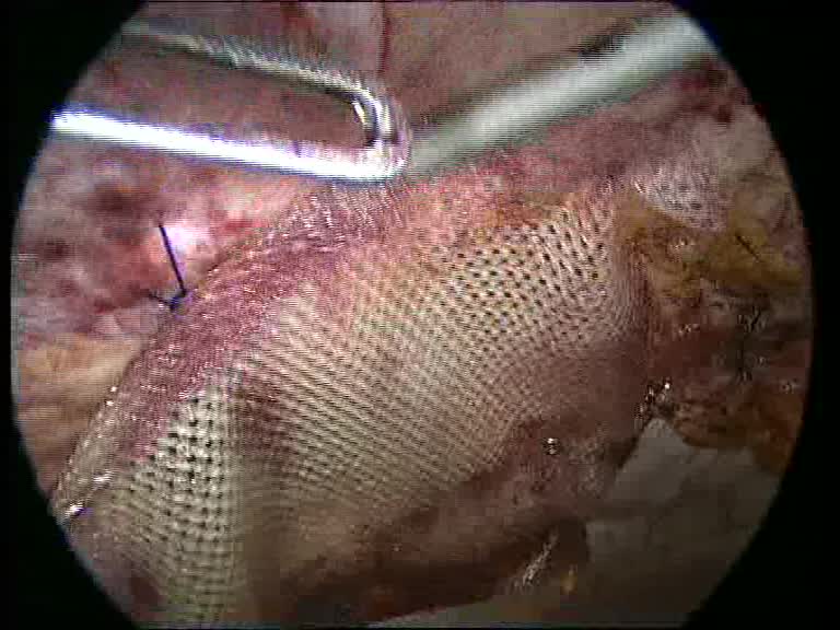 Tratamentul laparoscopic al herniei inghinale - Viața Medicală